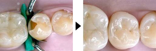 补牙是能维持多久？