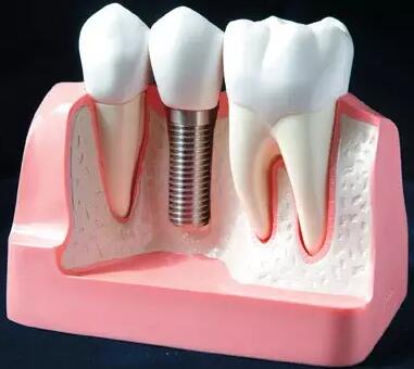 种植牙的利与弊？