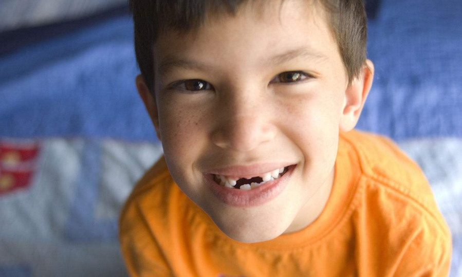 门牙缺失种植牙好吗？