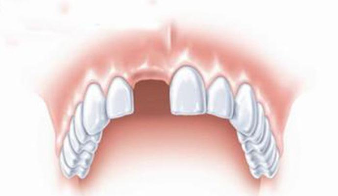 门牙缺失怎么补才好呢？