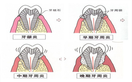 牙周炎和牙龈炎的区别？
