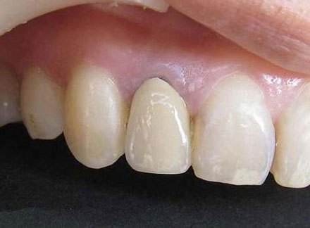 镶牙哪种材料比较好？
